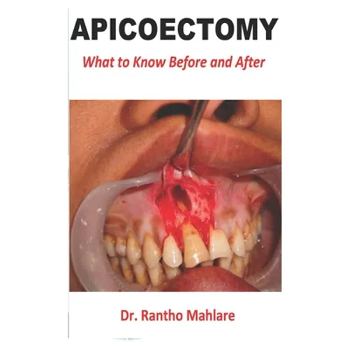 Apicoectomy: What to Know Before and After