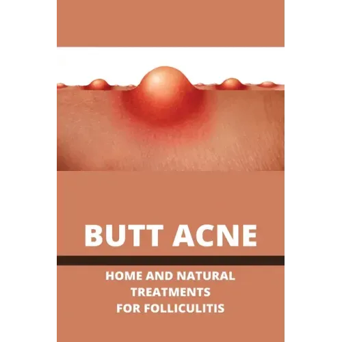 Butt Acne: Home And Natural Treatments For Folliculitis: Barber'S Itch Home Remedies