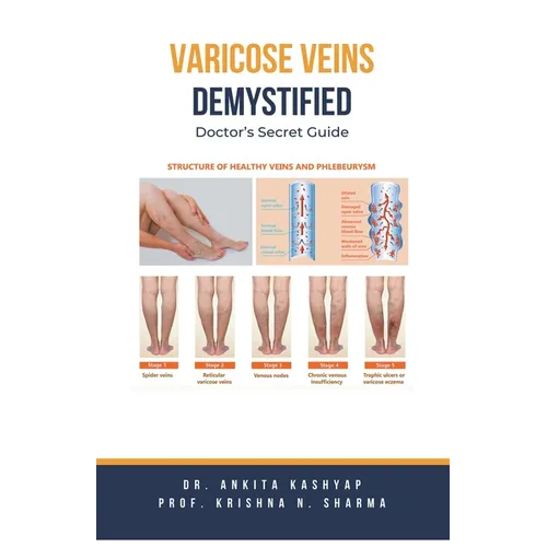 Varicose Veins Demystified: Doctor's Secret Guide