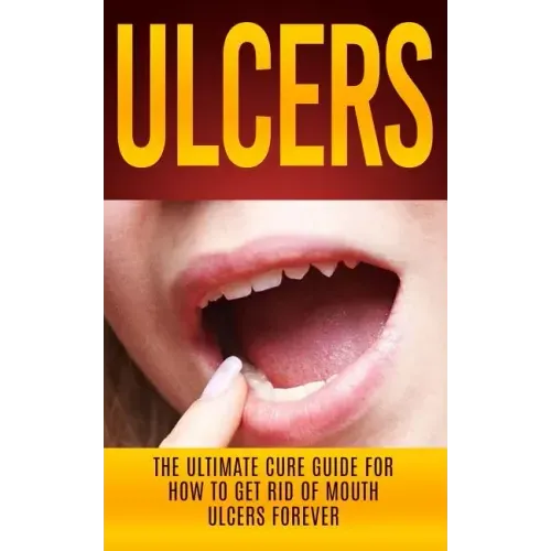 Ulcers: The Ultimate Cure Guide for How to Get Rid of Mouth Ulcers Instantly
