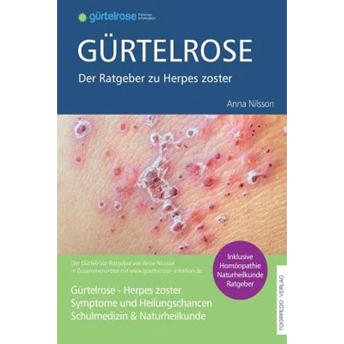 Gürtelrose - Der große Ratgeber zu Herpes zoster: Schulmedizin + Naturheilkunde