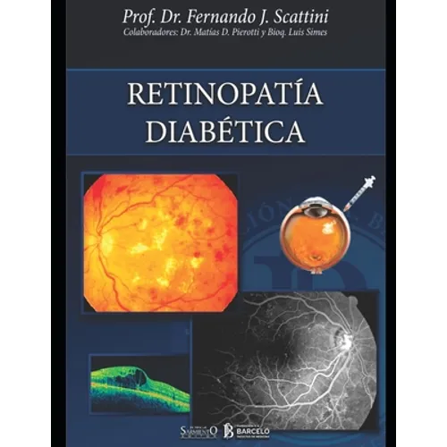 Retinopatía diabética: Oftalmología