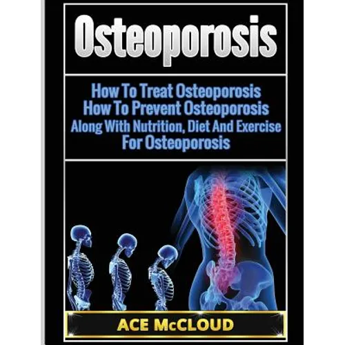 Osteoporosis: How To Treat Osteoporosis: How To Prevent Osteoporosis: Along With Nutrition, Diet And Exercise For Osteoporosis
