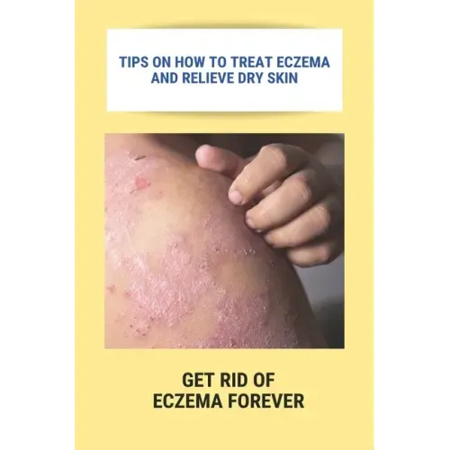 Tips On How To Treat Eczema And Relieve Dry Skin: Get Rid Of Eczema Forever: Overcome Eczema