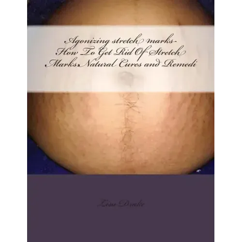 Agonizing stretch marks-How To Get Rid Of Stretch Marks: Natural Cures and Remedi