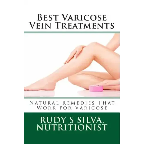 Best Varicose Vein Treatments: Natural Remedies That Work For Varicose