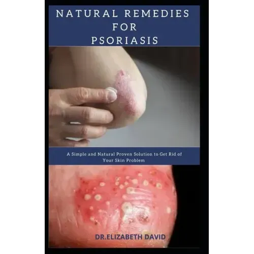 Natural Remedies for Psoriasis: A Simple and Natural Proven Solution to Get Rid of Your Skin Problem: Dermatitis, Eczema, Psoriasis & Rosacea and Othe