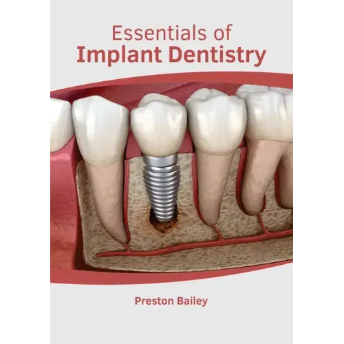 Essentials of Implant Dentistry